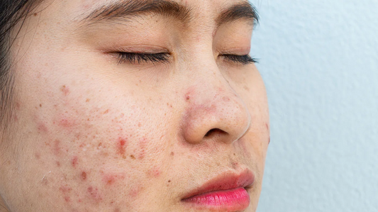Clear Skin Ahead: Say Goodbye to Pimples and Acne
